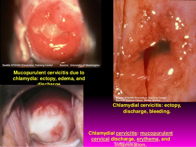 Hình ảnh nội soi của viêm lộ tuyến tử cung
