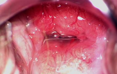 viem-lo-tuyen-co-tu-cung-2