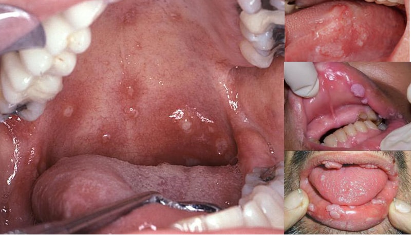 Hình ảnh chụp lại của một bệnh nhân mắc sùi mào gà ở miệng rất nặng