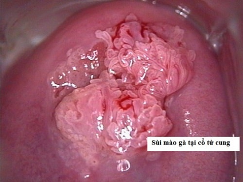 Hình ảnh sùi mào gà trong tử cung bệnh nhân nữ-min