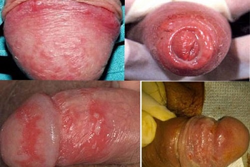 Hình ảnh khủng khiếp của bệnh viêm bao quy đầu