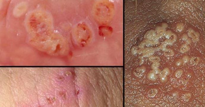 Vùng kín nổi mụn do nhiễm virus HPV